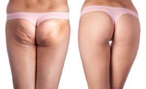 best-ways-to-eliminate-cellulite-and-lose-weight-r71o3