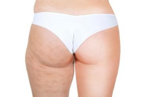 the-anti-cellulite-treatments-that-work-best-on-cellulite-fl647