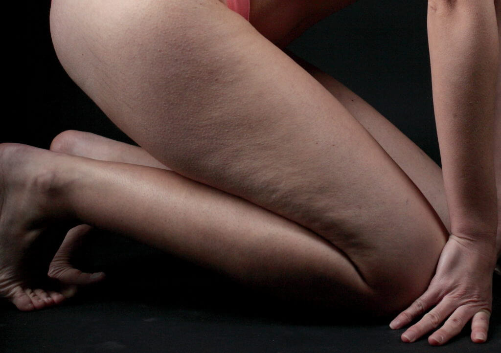 cellulite-on-thighs
